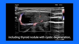 Identifying a Thyroglossal Duct Cyst on Ultrasound Key Findings and Differential Diagnosis [upl. by Ellivro]