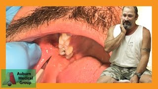 Periodontal Abscess [upl. by Aihcats621]