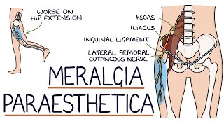 Understanding Meralgia Paraesthetica [upl. by Reinaldo284]