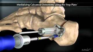 Medializing Calcaneal Osteotomy [upl. by Nauh]