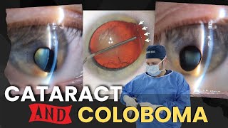 Colobomas amp Cataract Surgery  A Patients Case [upl. by Jadd]