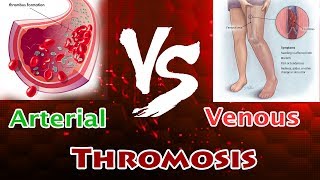 Arterial Thrombosis Vs Venous Thrombosis  Clear Comparison [upl. by Ylebmik]