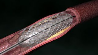 Coronary Artery Angioplasty  Radial Access [upl. by Huntley]