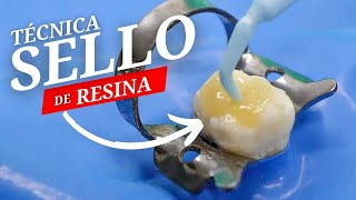 Tecnica de Sello para resina Dental [upl. by Yrahca938]