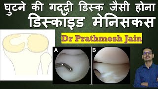 डिस्कॉइड मेनिसकस  विस्तृत जानकारी Discoid meniscus Detailed Information in Hindi [upl. by Silva70]