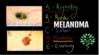 Melanoma  Symptoms signs diagnosis and management [upl. by Llecram983]