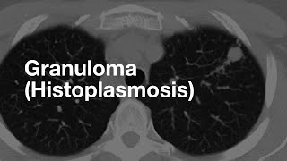 Classic Case Granuloma from Histoplasmosis [upl. by Rebliw]