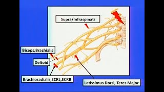 Brachial Plexus Injuries [upl. by Heiskell]