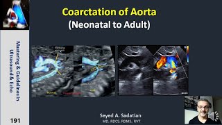 Coarctation of Aorta Neonatal to Adult [upl. by Tjader307]