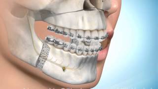 Chirurgische kaakcorrectie onder en bovenkaak [upl. by Nidnerb]