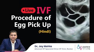 LIVE IVF Procedure of Egg Pick Up Hindi  Oocyte Retrieval  Dr Jay Mehta Mumbai  IVF in Hindi [upl. by Agler]