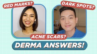 BEST Treatments for Acne Scars [upl. by Asina]