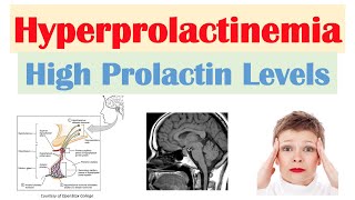 Hyperprolactinemia High Prolactin Levels  Causes Signs amp Symptoms Diagnosis Treatment [upl. by Vaclav701]