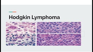 Hodgkin lymphoma [upl. by Shugart]