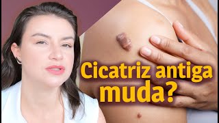 Como tratar uma cicatriz queloide ou hipertrófica antiga  Opinião de Esteticista [upl. by Yecal]