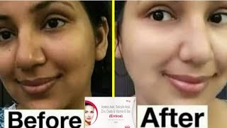 Entice Bar  Azelaic Acid  Acne scars  dark spot  Skin care  salicylic acid  Brijwasi Girl [upl. by Issej]