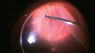 Vitrectomy for Giant Retinal Tear  2 Giant tears  GRT  Dr Manish Nagpal [upl. by Sabanrab]