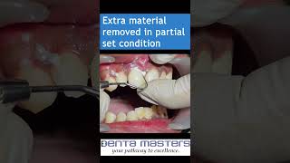 Cementation of Layered ZIRCONIA crown with GIC  step by step  shorts [upl. by Pius]