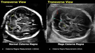 Edwards Syndrome Trisomy 18 Antenatal Ultrasound Features  Fetal USG Normal Vs Abnormal Images [upl. by Dickinson346]