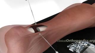 Surgical repair of a ruptured Achilles tendon [upl. by Neeven284]