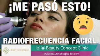 🥺😱 ME HICE RADIOFRECUENCIA facial luego de la Bichectomía ¡Y me pasó ESTO [upl. by Elak]