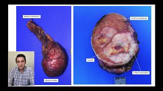 TUMOR TESTICULAR SEMINOMA [upl. by Broeder]