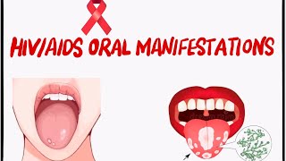 Oral Manifestations of HIVAIDS [upl. by Atirahc]