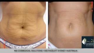 Stretch marks treatment with fraxel restore laser Sydney [upl. by Ober149]