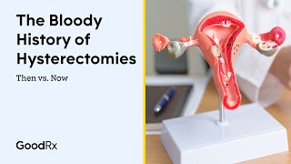 The History of Hysterectomies  Then vs Now  GoodRx [upl. by Ark]