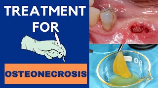 Treatment for bisphosphonaterelated osteonecrosis of the jaw  Live surgery [upl. by Pallas]