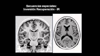 introducción a las neuroimágenes [upl. by Anastas]