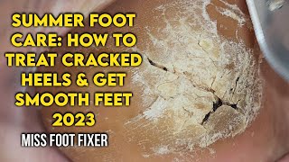 Summer Foot Care How to Treat Cracked Heels and Get Smooth Feet by foot Specialist Miss foot Fixer [upl. by Tilford]