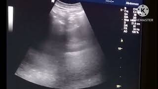 Retroperitoneal cyst on Ultrasound [upl. by Notlil686]