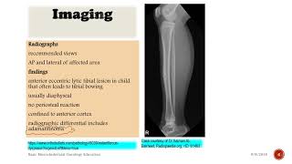 Osteofibrous Dysplasia [upl. by Rhine746]