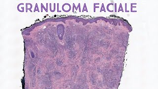 Granuloma faciale with erythema elevatum diutinumlike fibrosis pathology histology pronunciation [upl. by Calypso]