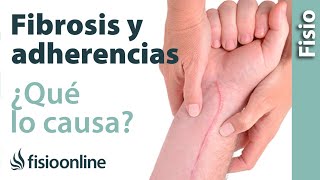 Fibrosis y adherencias  ¿Qué es y cuáles son sus causas [upl. by Wyn356]