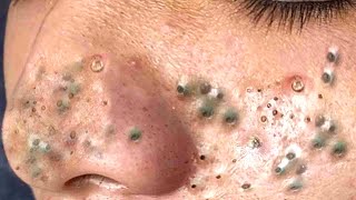 Big Cystic Acne Blackheads Extraction Blackheads amp Milia Whiteheads Removal Pimple Popping  9014 [upl. by Hindorff]