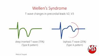 Wellens Syndrome with ECG and Angiography example [upl. by Ttegirb411]