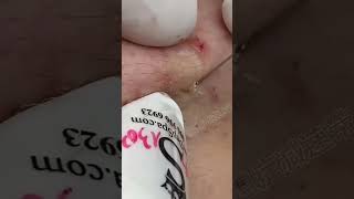 Blackhead Removal Acne Removal Treatment 010 [upl. by Solegnave872]