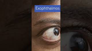 Exophthalmos imwell Exophthalmos [upl. by Nemzzaj673]