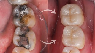 Ceramic ONLAY amp OVERLAY cementation StepbyStep [upl. by Cesaro25]