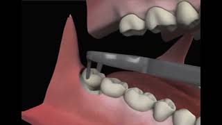 Third Molar Extraction Wisdom Teeth [upl. by Gabriella36]