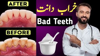 how to remove plaqueb danto ka peela pan kaise door kare  healthy teeth [upl. by Nyrmak]