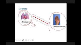 Cardiopathie congénitale [upl. by Oivlis574]