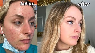 MY ACCUTANE JOURNEY  my acne experience QampA tips  pictures [upl. by Ianaj759]