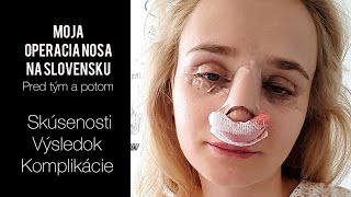 OPERÁCIA NOSA  moja skúsenosť [upl. by Neenwahs]