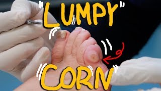 Satisfying Corn Removal with Callus HUGE LUMPY Corn [upl. by Rollet]