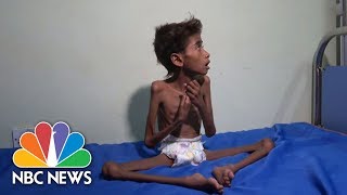 The Face Of Suffering Famine Cholera Wreak Havoc In WarTorn Yemen  NBC News [upl. by Ytinav]