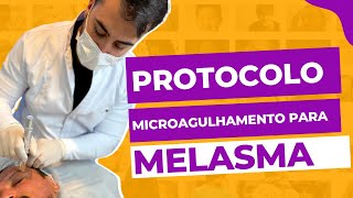 Protocolo Microagulhamento para Melasma com Nano Ozonioterapia  por Heitor Cruz [upl. by Buckden]