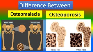 Difference Osteomalacia and Osteoporosis [upl. by Oidgime167]